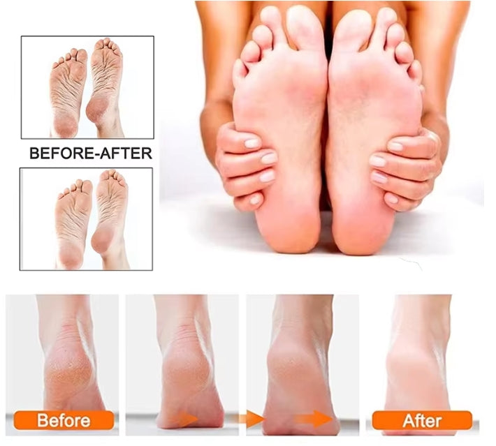 Set Callus Remover